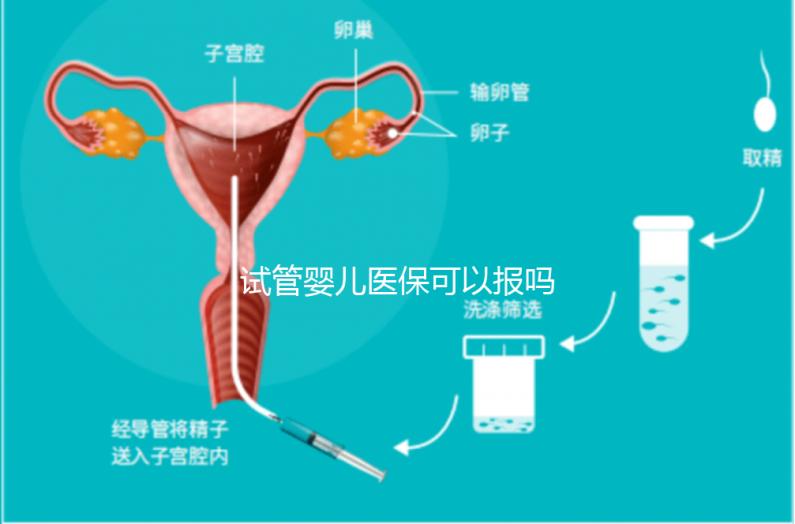 試管嬰兒醫(yī)保可以報嗎